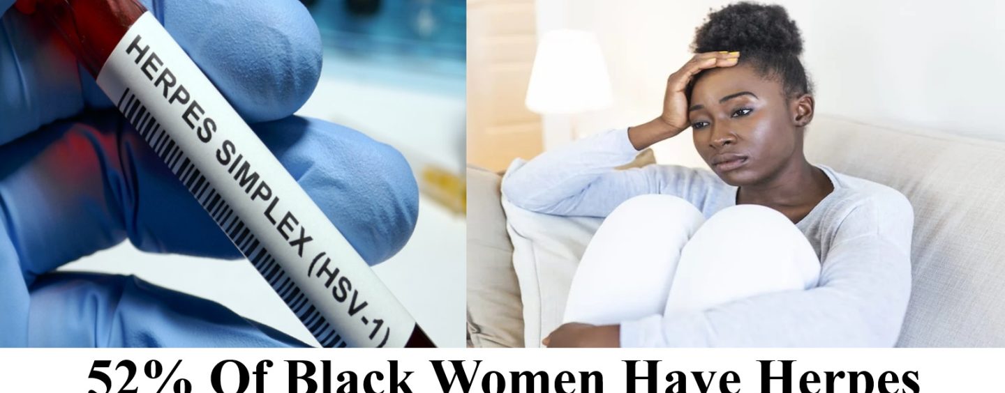 52% Of Black Women Have Genital Herpes! What Does This Say About Them To You? Lets Talk About It! (Live Twitter Space Show)
